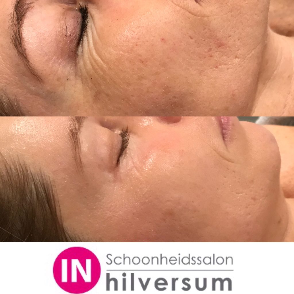 Schoonheidssalon IN Hilversum - bindweefsel massage